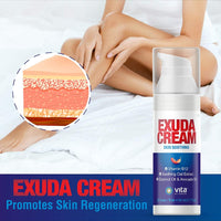 Exuda Cream Eczema Pain Relief Cream